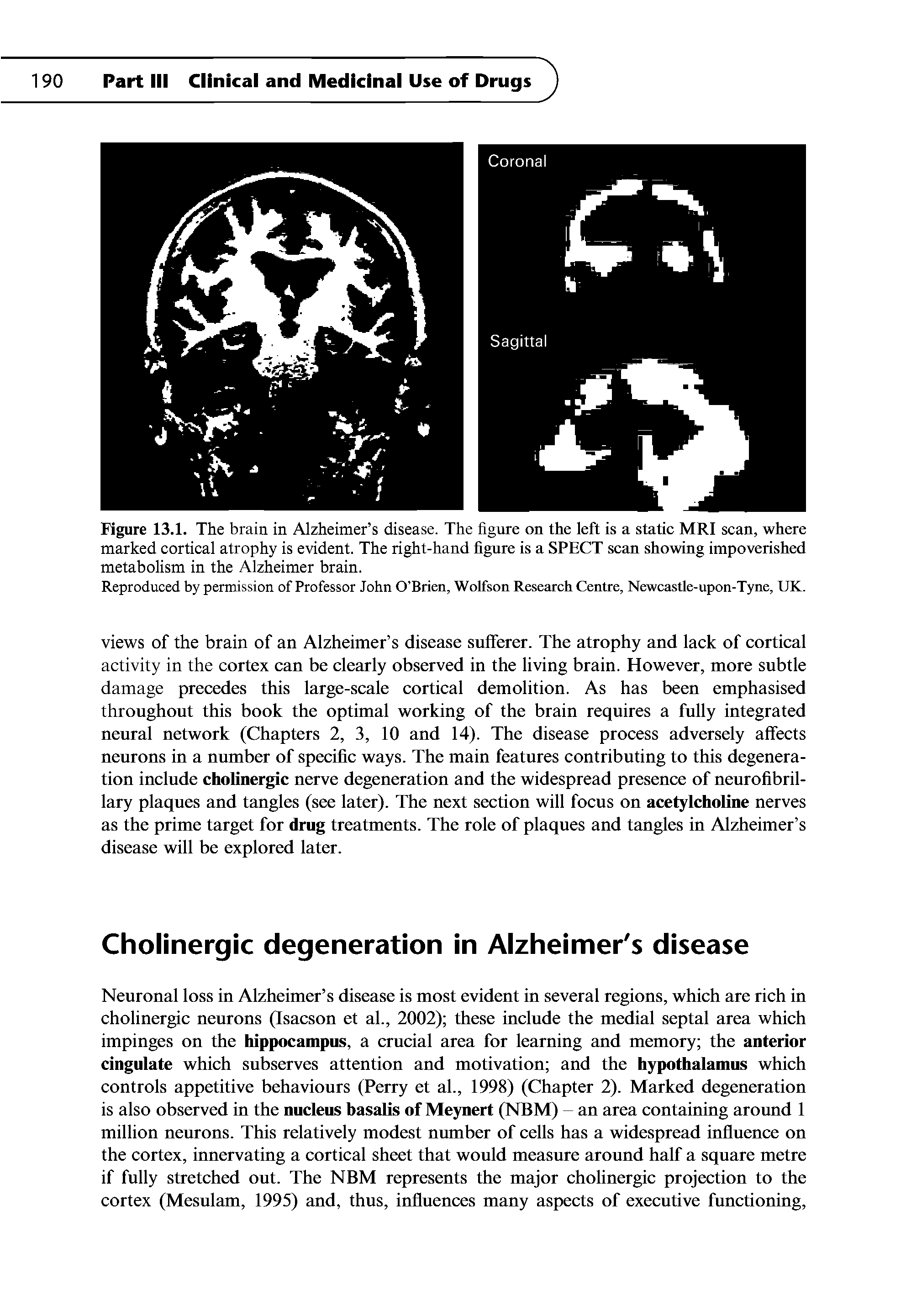 Figure 13.1. The brain in Alzheimer s disease. The figure on the left is a static MRI scan, where marked cortical atrophy is evident. The right-hand figure is a SPECT scan showing impoverished metabolism in the Alzheimer brain.
