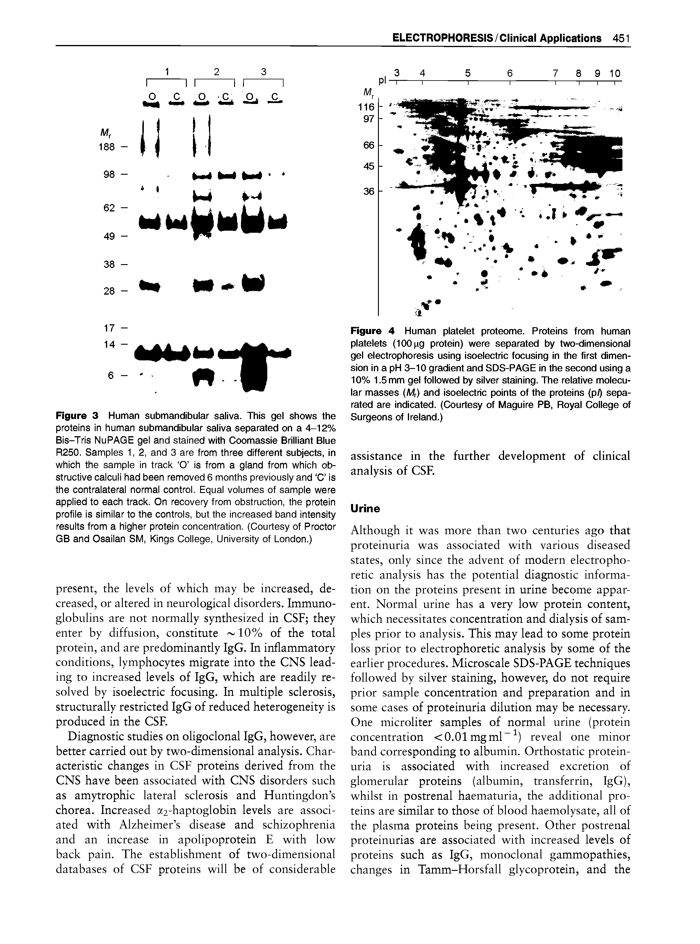 Figure 3 Human submandibular saliva. This gel shows the proteins in human submandibular saliva separated on a 4-12% Bis-Tris NuPAGE gel and stained with Coomassie Brilliant Blue R250. Samples 1, 2, and 3 are from three different subjects, in which the sample in track O is from a gland from which obstructive calculi had been removed 6 months previously and C is the contralateral normal control. Equal volumes of sample were applied to each track. On recovery from obstruction, the protein profile Is similar to the controls, but the increased band intensity results from a higher protein concentration. (Courtesy of Proctor GB and Osailan SM, Kings College, University of London.)...