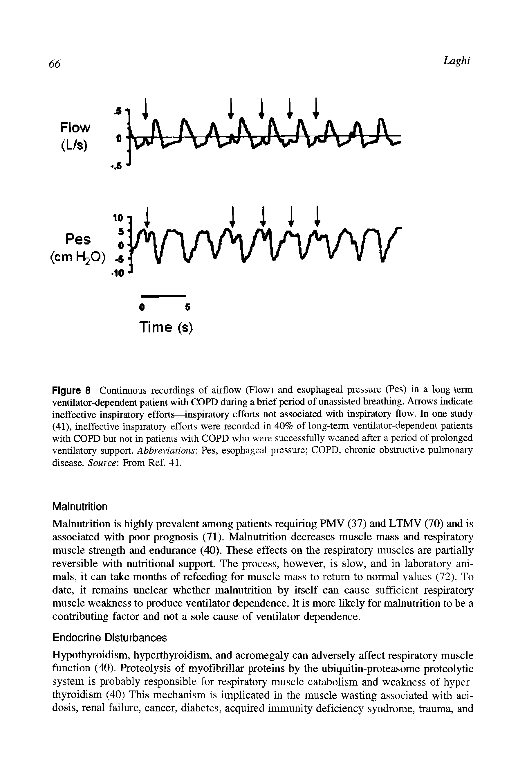 Figure 8 Continuous recordings of airflow (Flow) and esophageal pressure (Pes) in a long-term ventilator-dependent patient with COPD during a brief period of unassisted breathing. Arrows indicate ineffective inspiratory efforts—inspiratory efforts not associated with inspiratory flow. In one study (41), ineffective inspiratory efforts were recorded in 40% of long-term ventilator-dependent patients with COPD but not in patients with COPD who were successfully weaned after a period of prolonged ventilatory support. Abbreviations Pes, esophageal pressure COPD, chronic obstructive pulmonary disease. Source From Ref. 41.