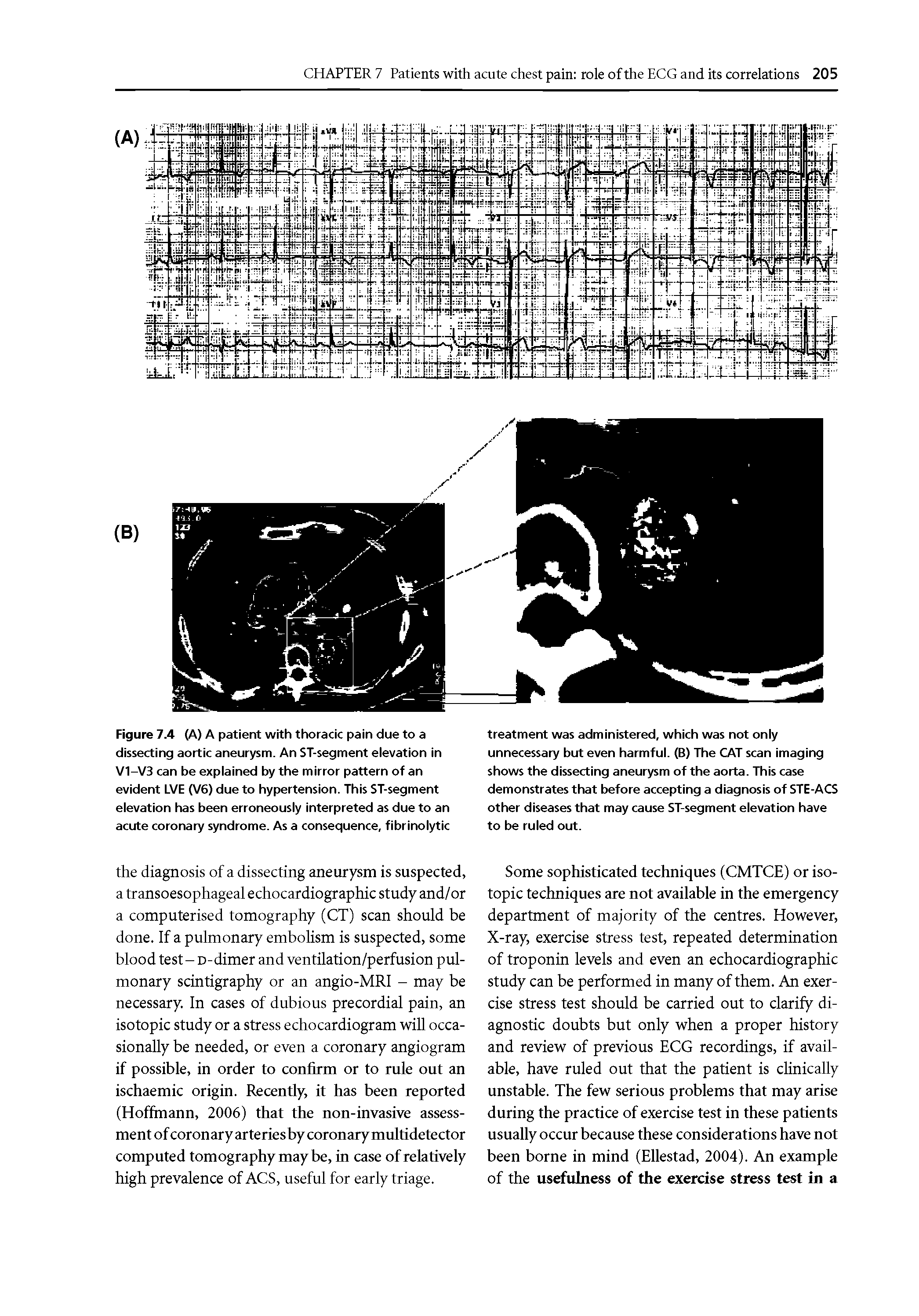 Figure 7.4 (A) A patient with thoracic pain due to a dissecting aortic aneurysm. An ST-segment elevation in V1-V3 can be explained by the mirror pattern of an evident LVE (V6) due to hypertension. This ST-segment elevation has been erroneously interpreted as due to an acute coronary syndrome. As a consequence, fibrinolytic...