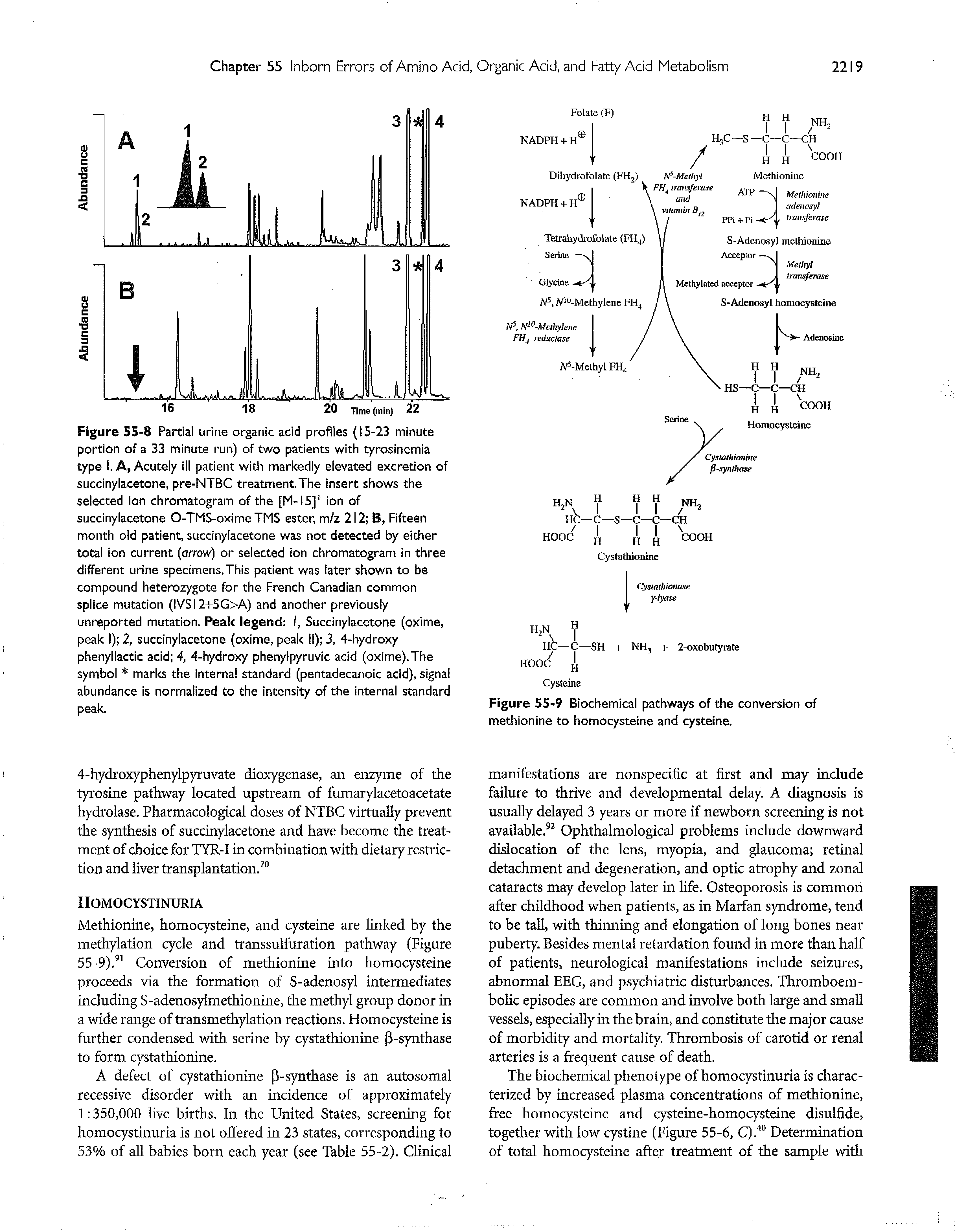 Figure 55-8 Partial urine organic acid profiles 15-23 minute portion of a 33 minute run) of two patients with tyrosinemia type i. A, Acutely III patient with markedly elevated excretion of succiny[acetone, pre-NTBC treatment.The insert shows the selected ion chromatogram of the [M-15] ion of succinylacetone O-TMS-oxime TMS ester, m/z 212 B, Fifteen month old patient, succinylacetone was not detected by either total ion current (orrow) or selected ion chromatogram in three different urine specimens.This patient was later shown to be compound heterozygote for the French Canadian common splice mutation (IVS12+5G>A) and another previously unreported mutation. Peak legend I, Succinylacetone (oxime, peak I) 2, succinylacetone (oxime, peak II) 3, 4-hydroxy phenyllactic acid 4, 4-hydroxy phenylpyruvic add (oxime).The symbol marks the internal standard (pentadecanoic acid), signal abundance is normalized to the intensity of the internal standard peak.