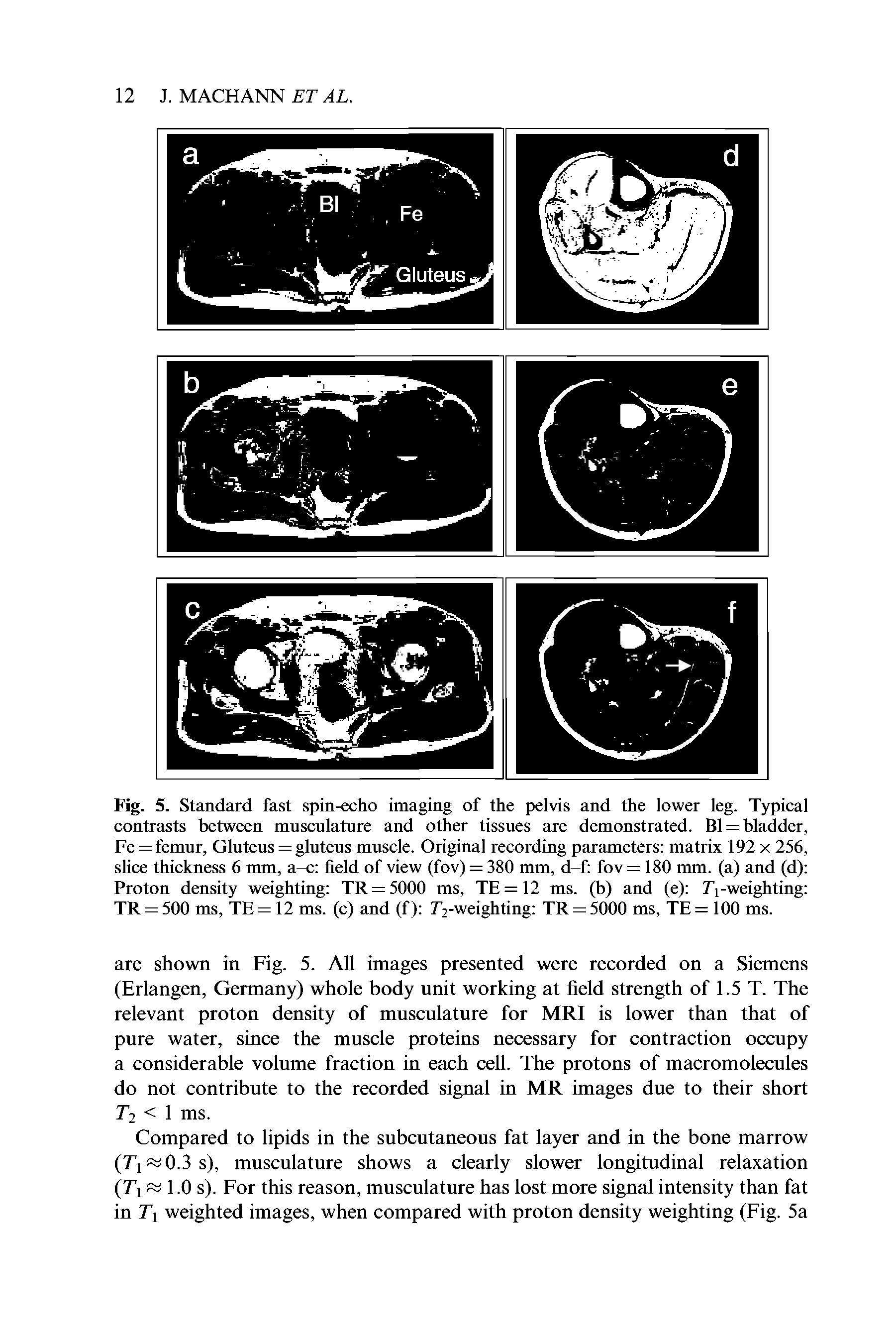 Fig. 5. Standard fast spin-echo imaging of the pelvis and the lower leg. Typical contrasts between musculature and other tissues are demonstrated. Bl = bladder, Fe = femur. Gluteus = gluteus muscle. Original recording parameters matrix 192 x 256, slice thickness 6 mm, a-c field of view (fov) = 380 mm, d-f fov = 180 mm. (a) and (d) Proton density weighting TR = 5000 ms, TE = 12 ms. (b) and (e) Ti-weighting TR = 500 ms, TE = 12 ms. (c) and (f) 7 2-weighting TR = 5000 ms, TE = 100 ms.