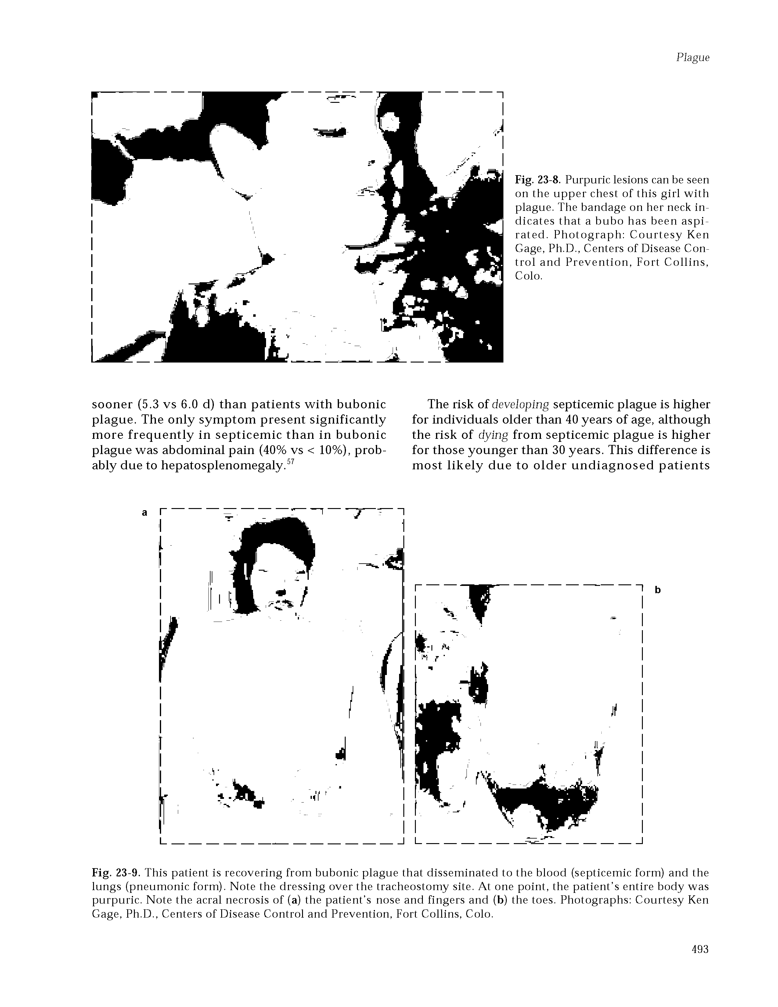 Fig. 23-9. This patient is recovering from bubonic plague that disseminated to the blood (septicemic form) and the lungs (pneumonic form). Note the dressing over the tracheostomy site. At one point, the patient s entire body was purpuric. Note the acral necrosis of (a) the patient s nose and fingers and (b) the toes. Photographs Courtesy Ken Gage, Ph.D., Centers of Disease Control and Prevention, Fort Collins, Colo.