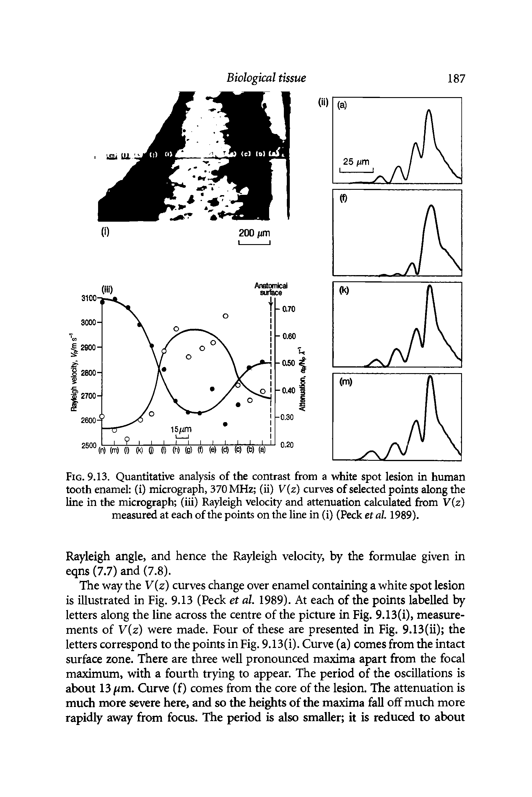 Fig. 9.13. Quantitative analysis of the contrast from a white spot lesion in human tooth enamel (i) micrograph, 370 MHz (ii) V(z) curves of selected points along the line in the micrograph (iii) Rayleigh velocity and attenuation calculated from V(z) measured at each of the points on the line in (i) (Peck et al. 1989).