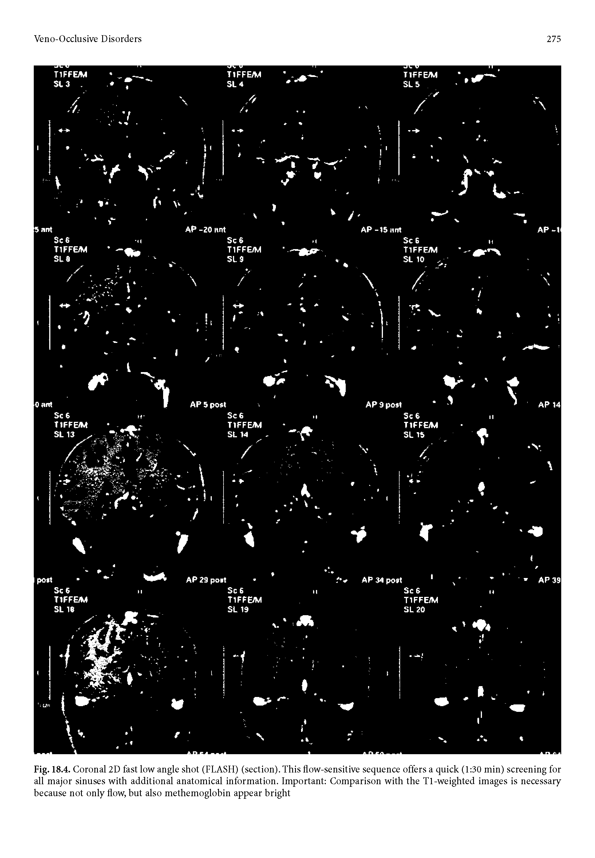 Fig. 18.4. Coronal 2D fast low angle shot (FLASH) (section). This flow-sensitive sequence offers a quick (1 30 min) screening for all major sinuses with additional anatomical information. Important Comparison with the Tl-weighted images is necessary because not only flow, but also methemoglobin appear bright...