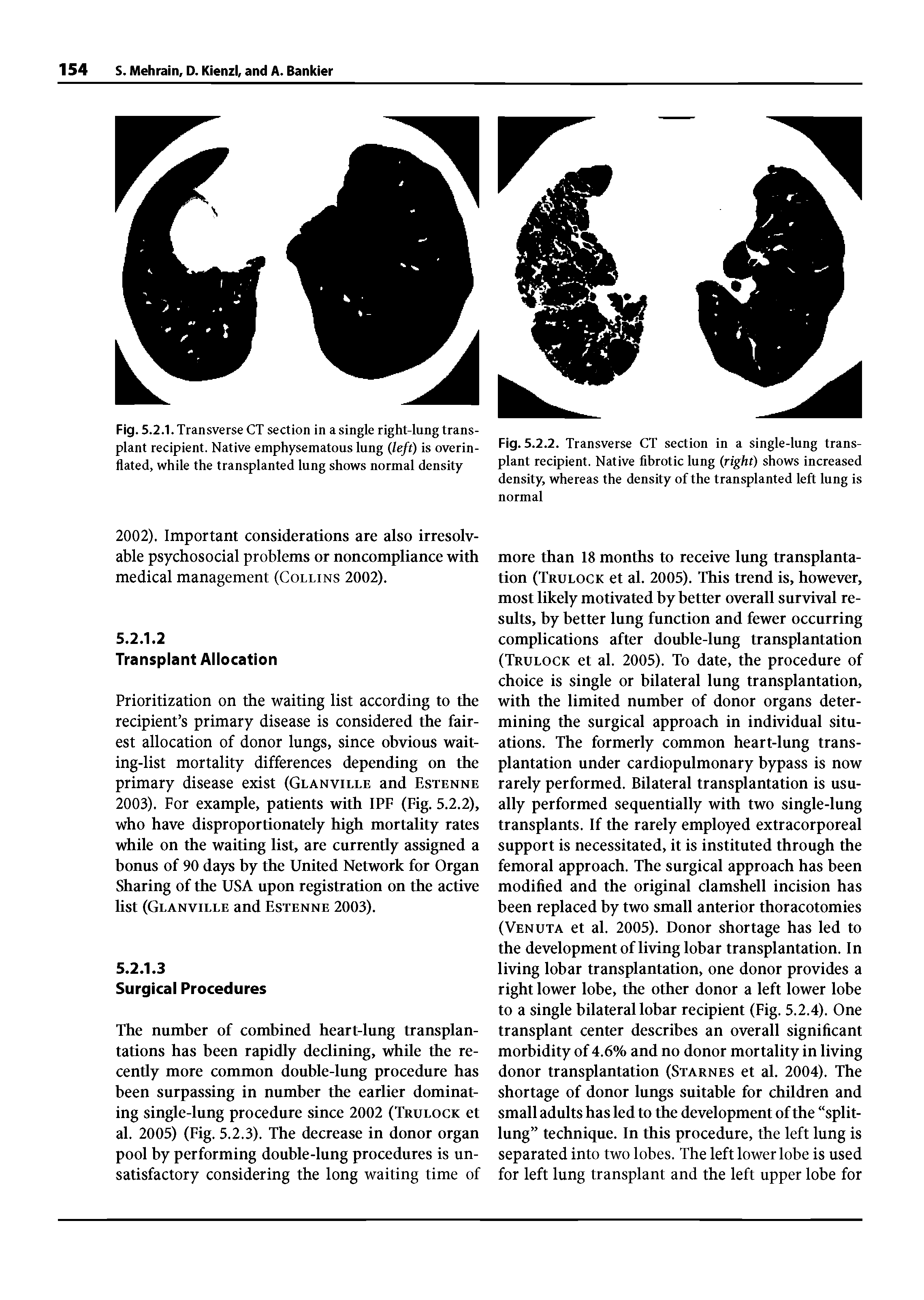 Fig. 5.2.2. Transverse CT section in a single-lung transplant recipient. Native lihrotic lung (right) shows increased density, whereas the density of the transplanted left lung is normal...