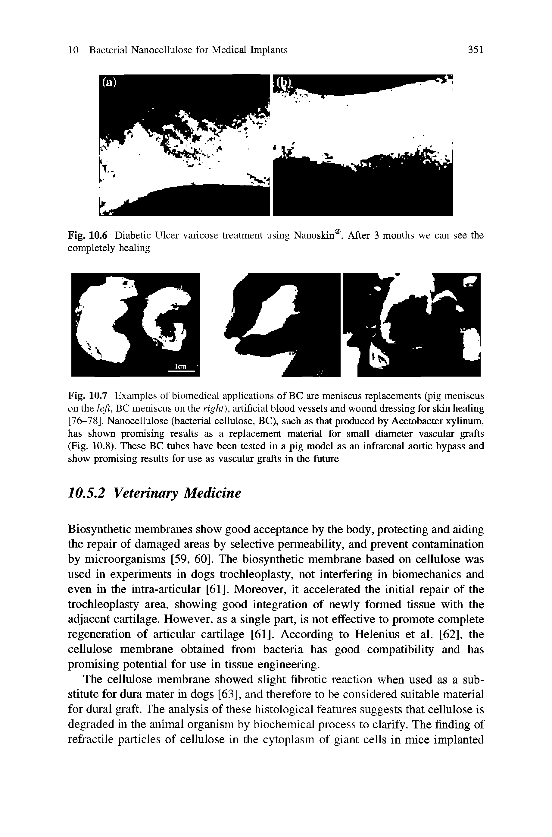 Fig. 10.7 Examples of biomedical applications of BC are meniscus replacements (pig meniscus on the left, BC meniscus on the right), artificial blood vessels and wound dressing for skin heaiing [76-78], Nanocellulose (bacterial cellulose, BC), such as that produced by Acetobacter xylinum, has shown promising results as a replacement material for small diameter vascular grafts (Fig. 10.8). These BC tubes have been tested in a pig model as an infrarcnal aortic bypass and show promising results for use as vascular grafts in the future...